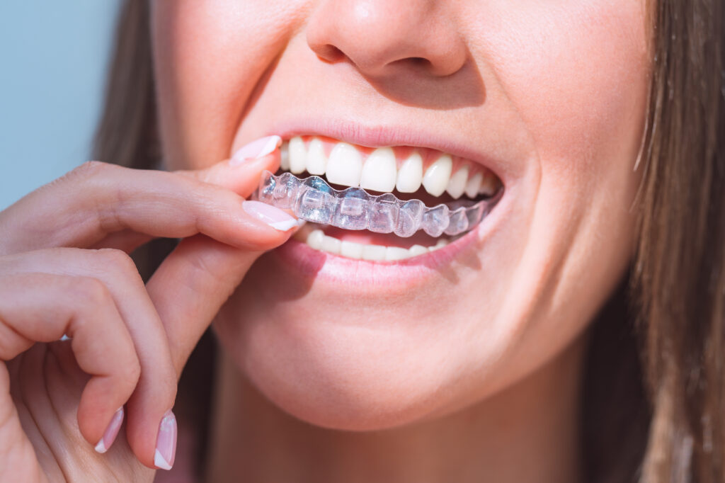 What Is a Retainer and Why Do You Need It After Braces or Invisalign?