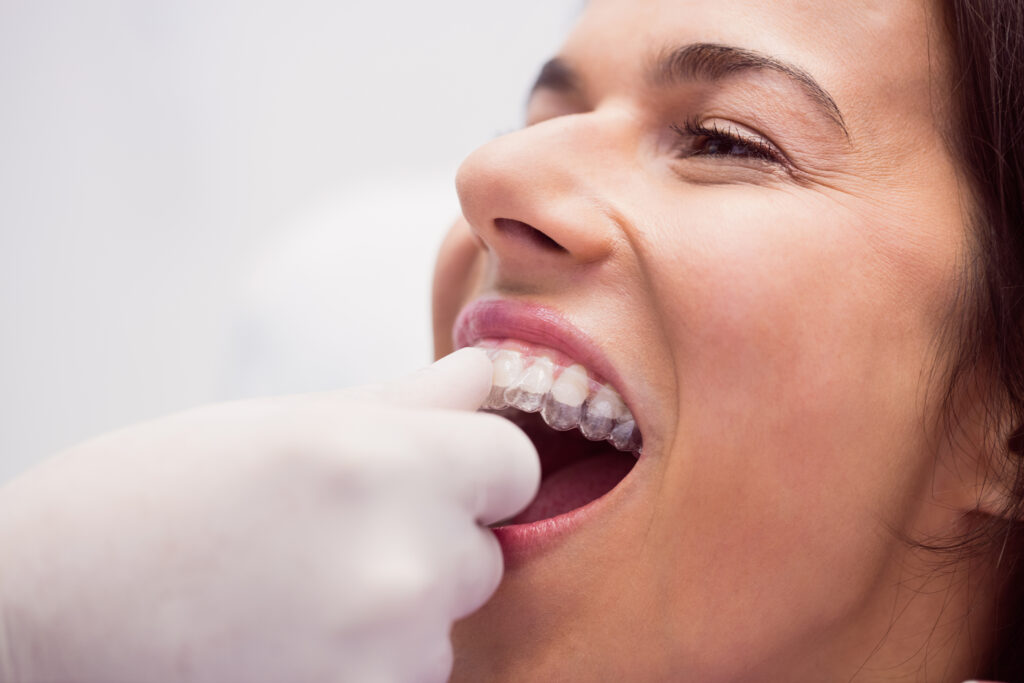 What Is a Retainer and Why Do You Need It After Braces or Invisalign?