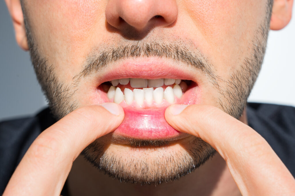 What Causes Crooked Teeth?
